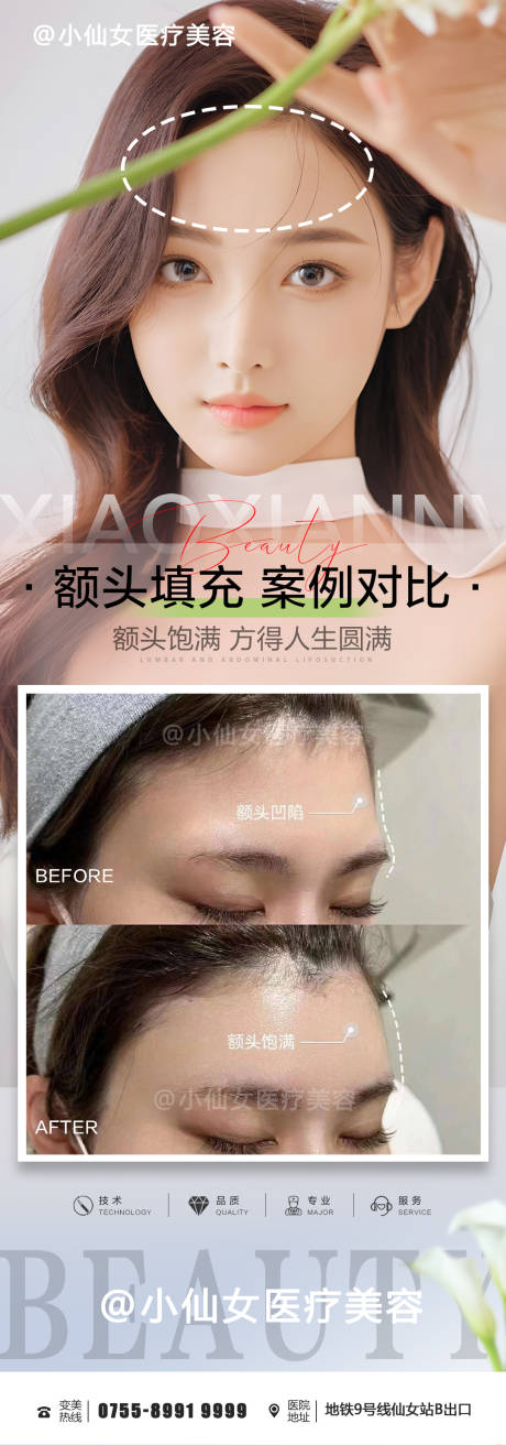 源文件下载【医美整形额头填充朋友圈案例海报】编号：81110015318613343