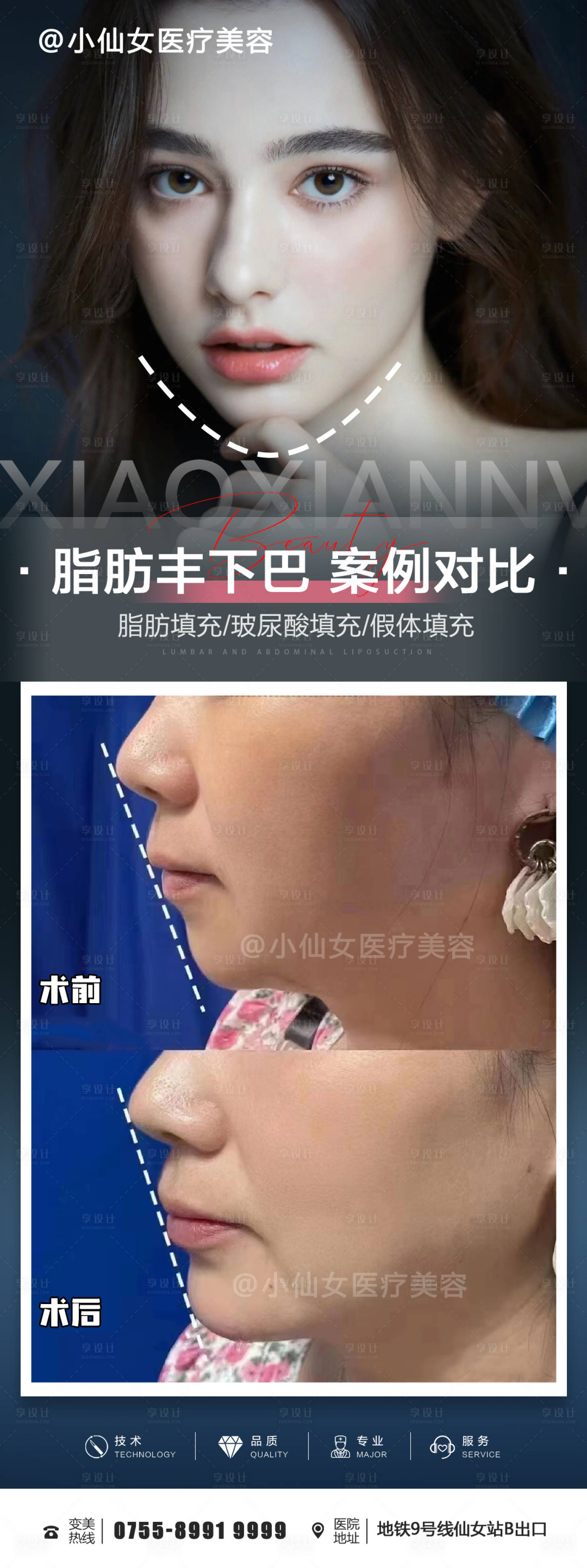 源文件下载【享设计】搜索编号：12090015229963816【医美整形丰下巴朋友圈案例海报】