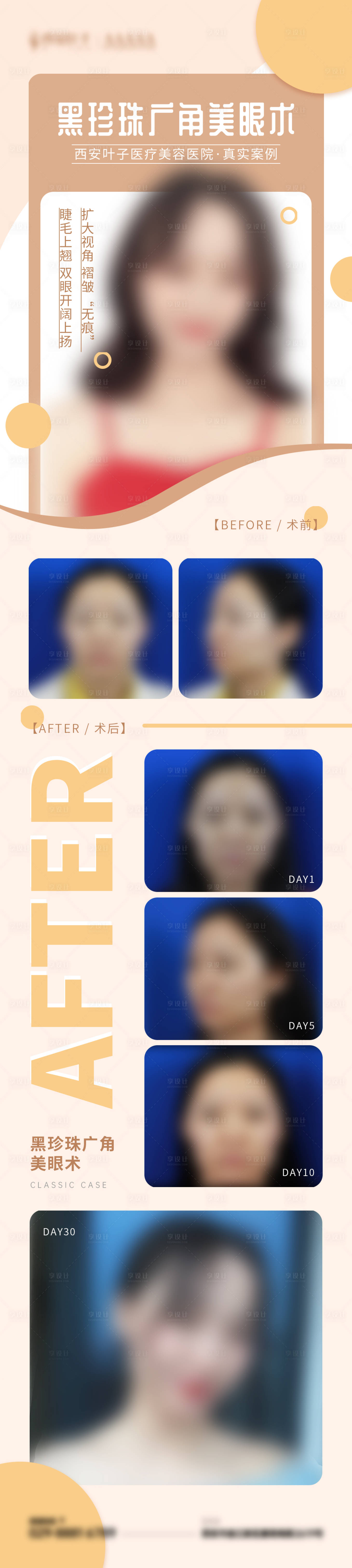 源文件下载【享设计】搜索编号：82690015672673950【医美双眼皮案例对比长图海报】