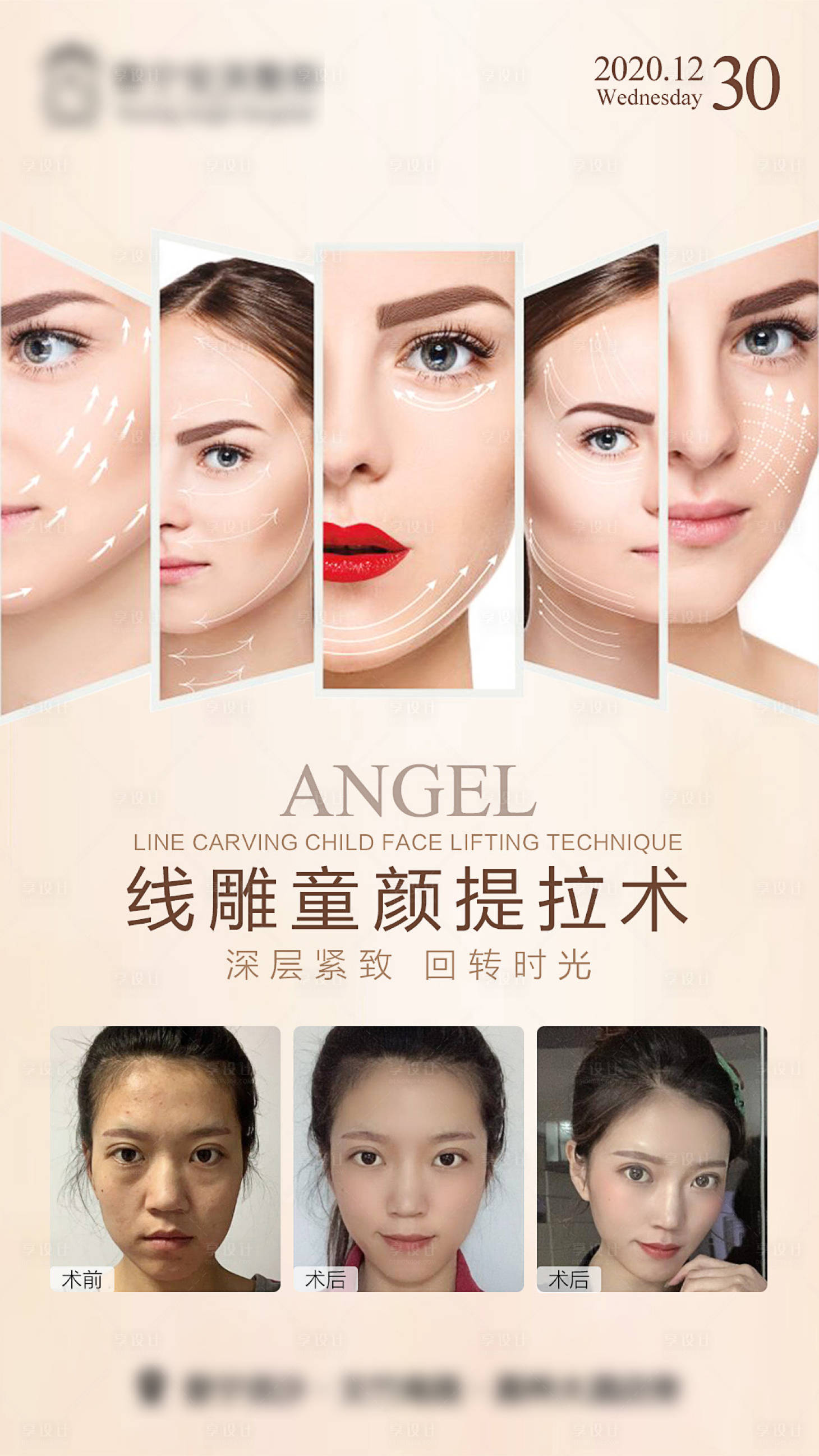 源文件下载【医美线雕海报】编号：71450015332963795