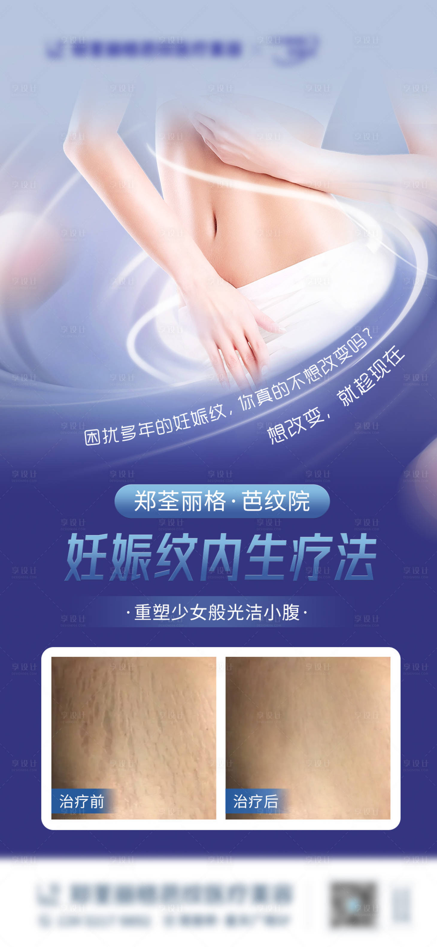 源文件下載【享設計】搜索編號：30130015277301431【妊娠紋醫美移動端海報】