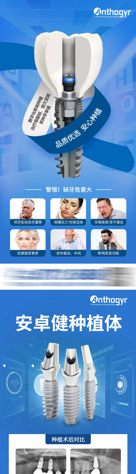 源文件下载【享设计】搜索编号：17570015377098614【种植体种植牙海报】