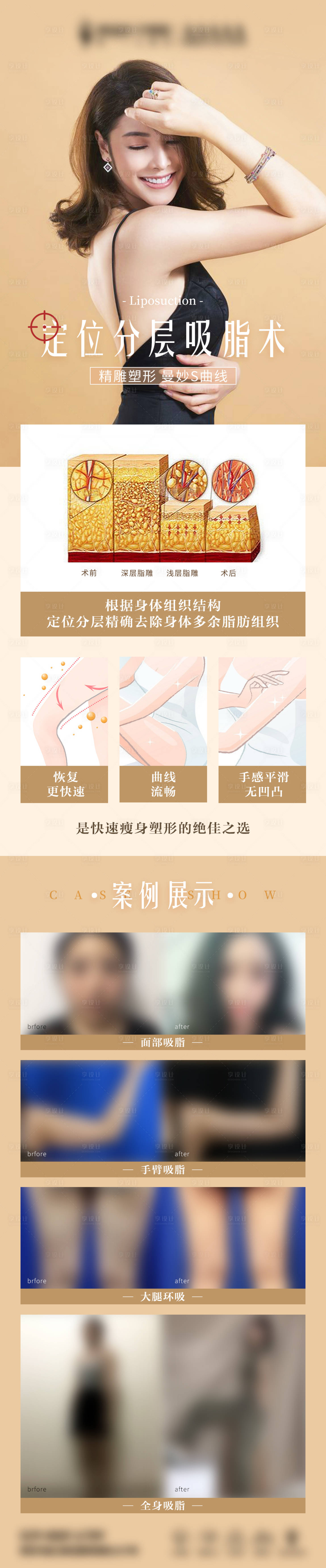 源文件下載【享設(shè)計(jì)】搜索編號(hào)：22010015700421035【醫(yī)美吸脂科普案例長圖】