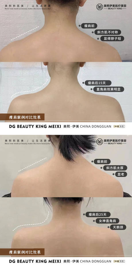 源文件下載【享設計】搜索編號：24940015338946388【瘦肩案例對比海報】