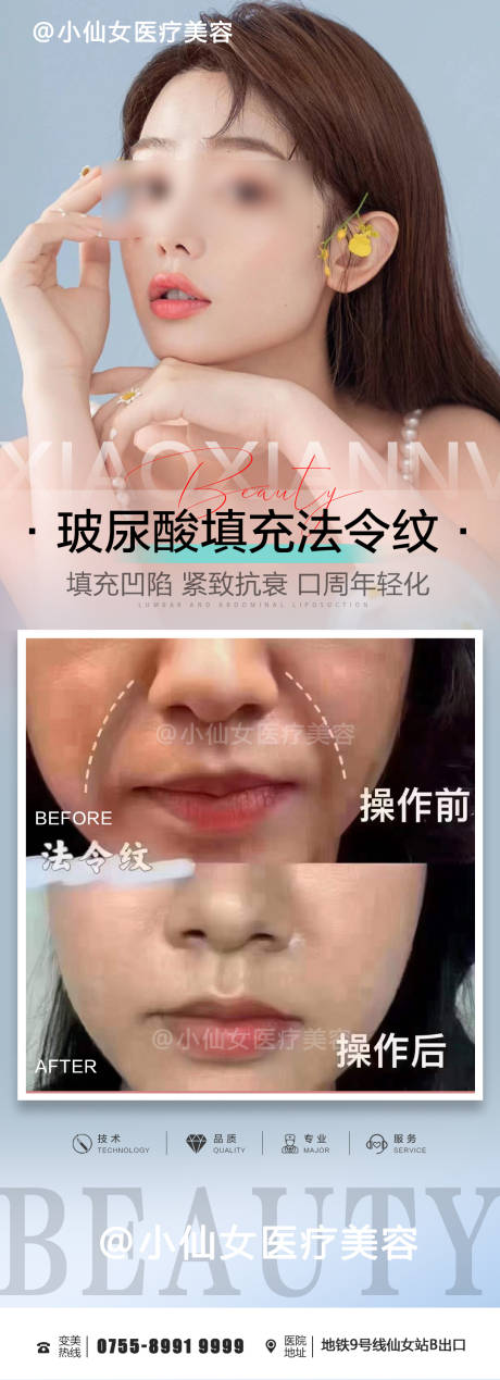 源文件下载【医美玻尿酸填充法令纹案例海报】编号：91220015393471109