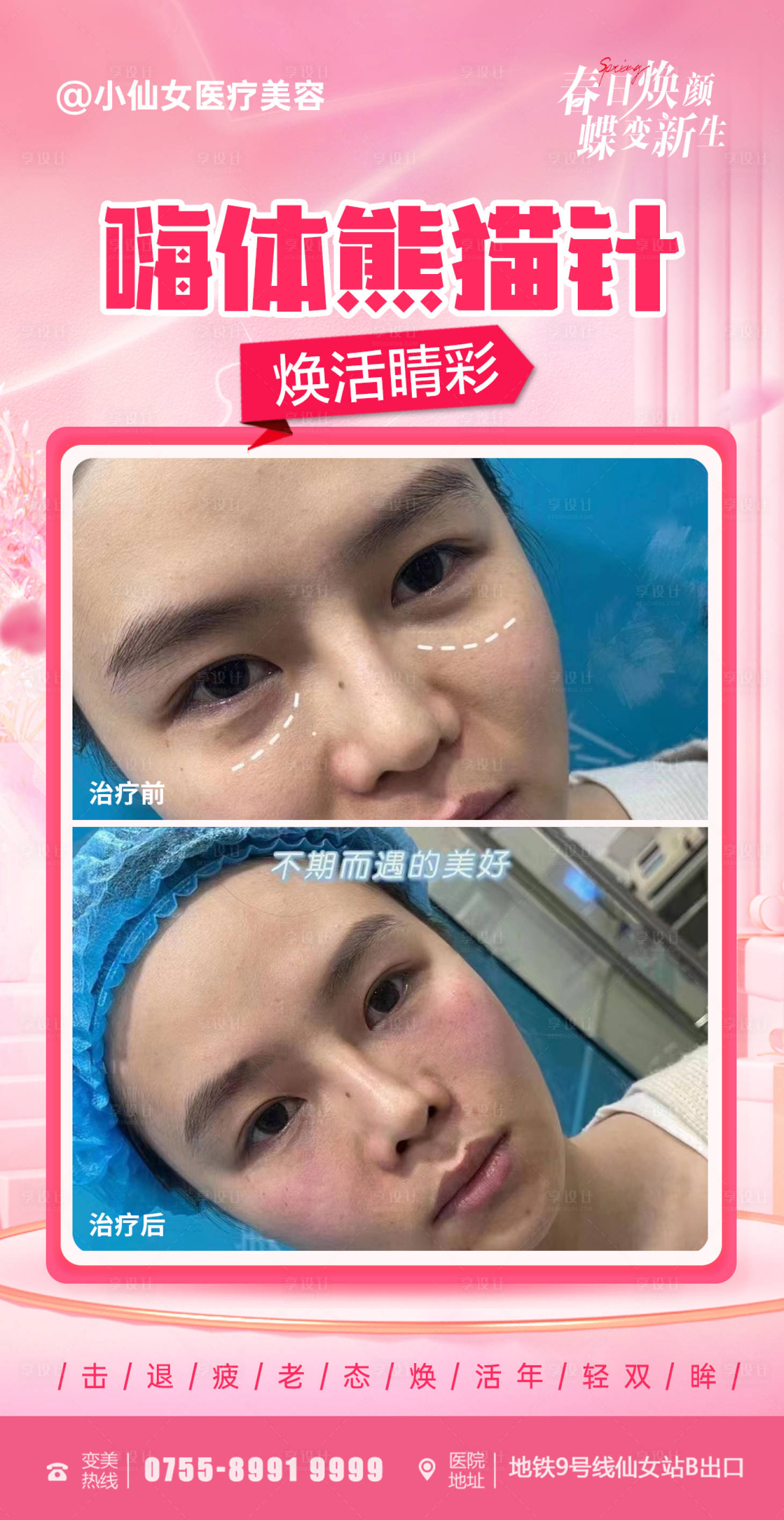 源文件下载【享设计】搜索编号：32890015287809444【医美嗨体熊猫针宣传案例海报】
