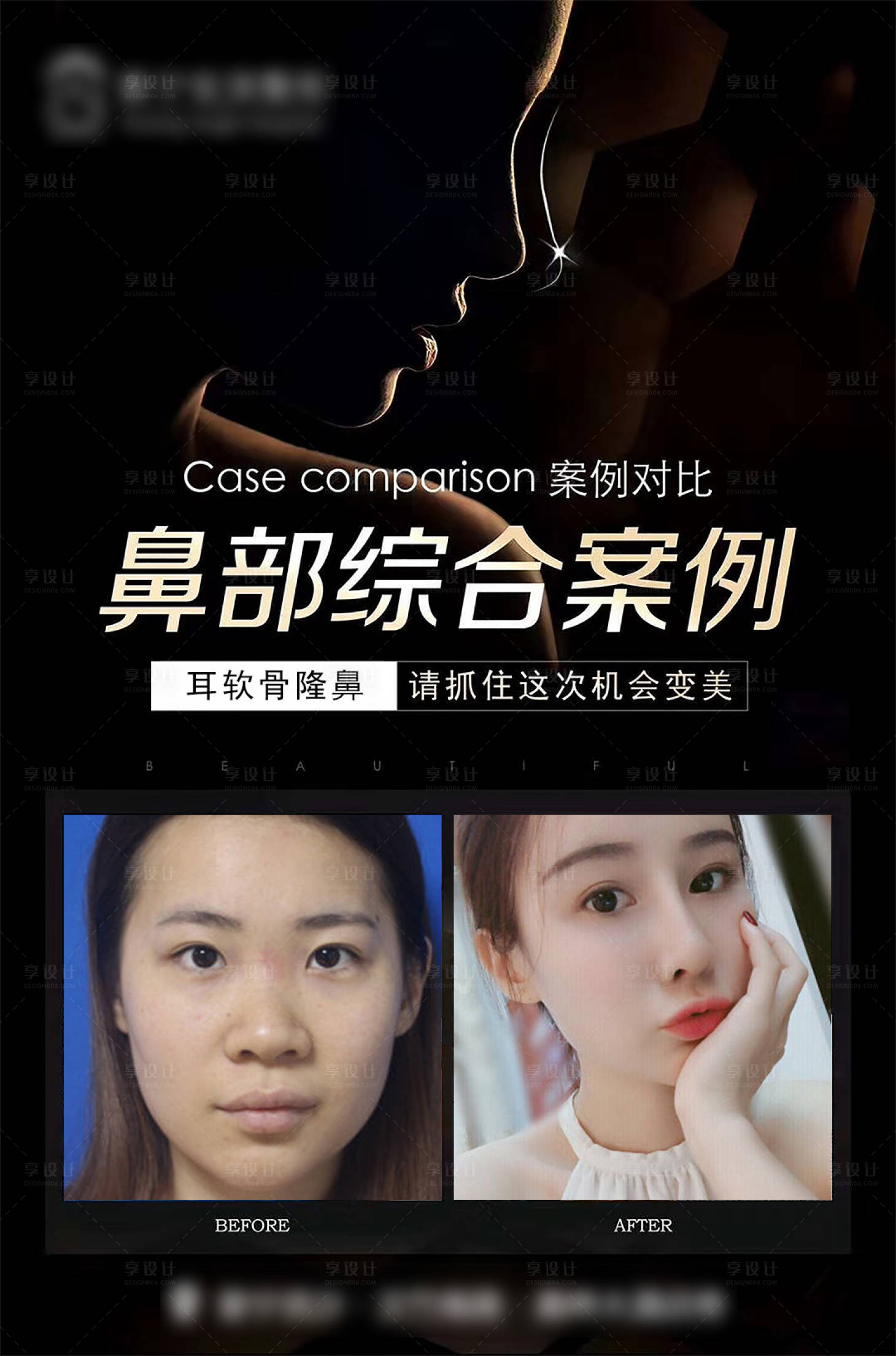 源文件下載【享設計】搜索編號：88640015414496675【醫美隆鼻案例】