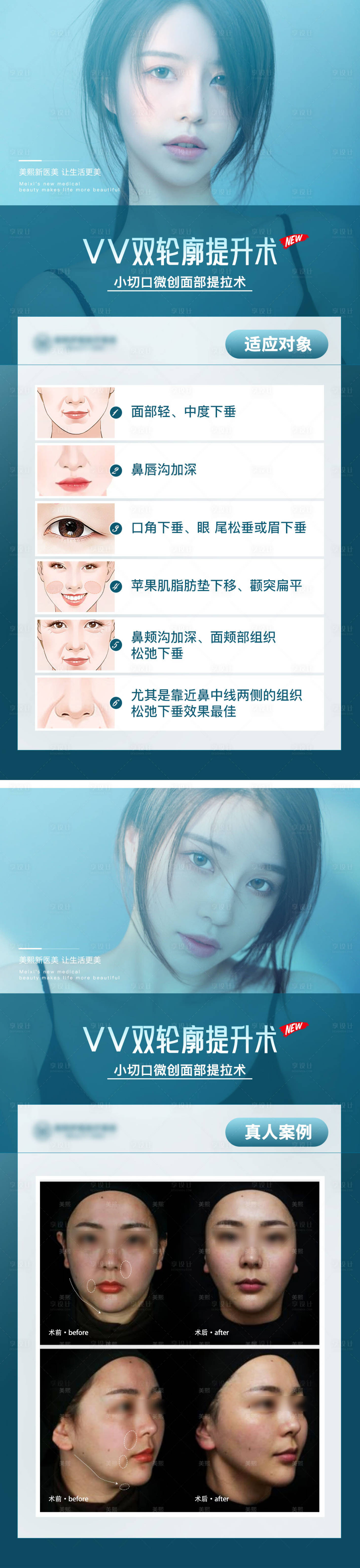 源文件下载【享设计】搜索编号：12320015336905883【VV双轮廓提升科普】