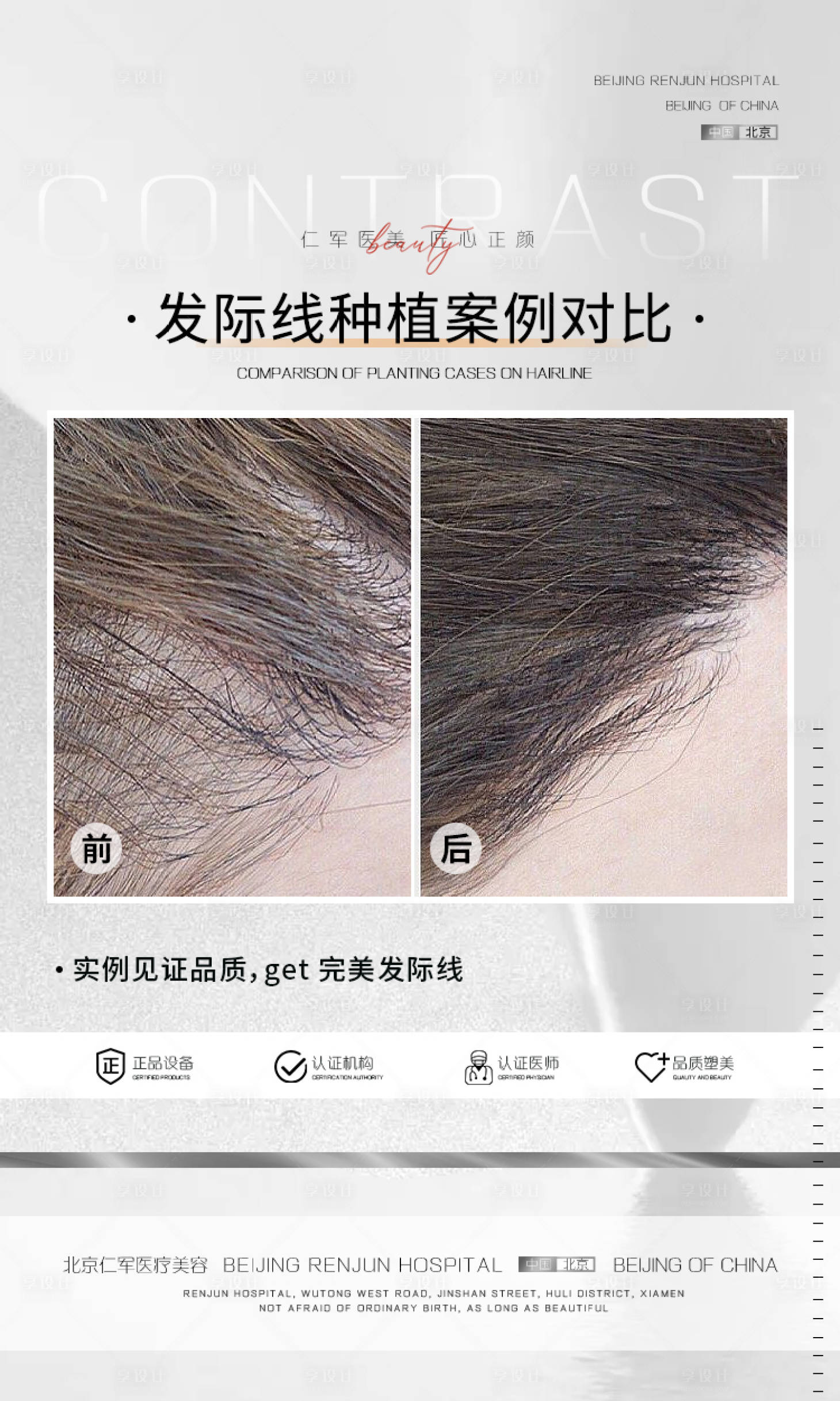 源文件下載【享設計】搜索編號：68690015435083796【醫美美業植發案例活動海報】