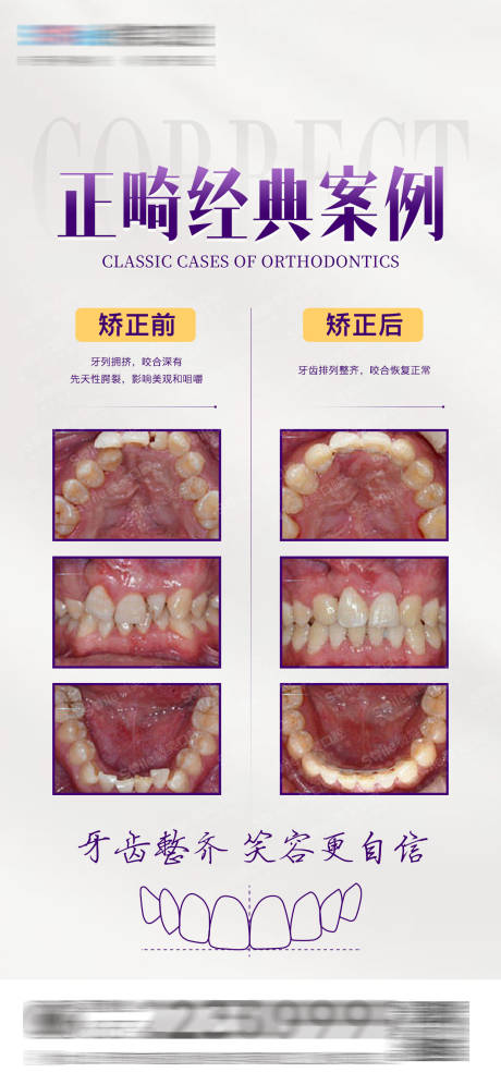 源文件下载【医美口腔正畸案例对比海报】编号：97770015685716938