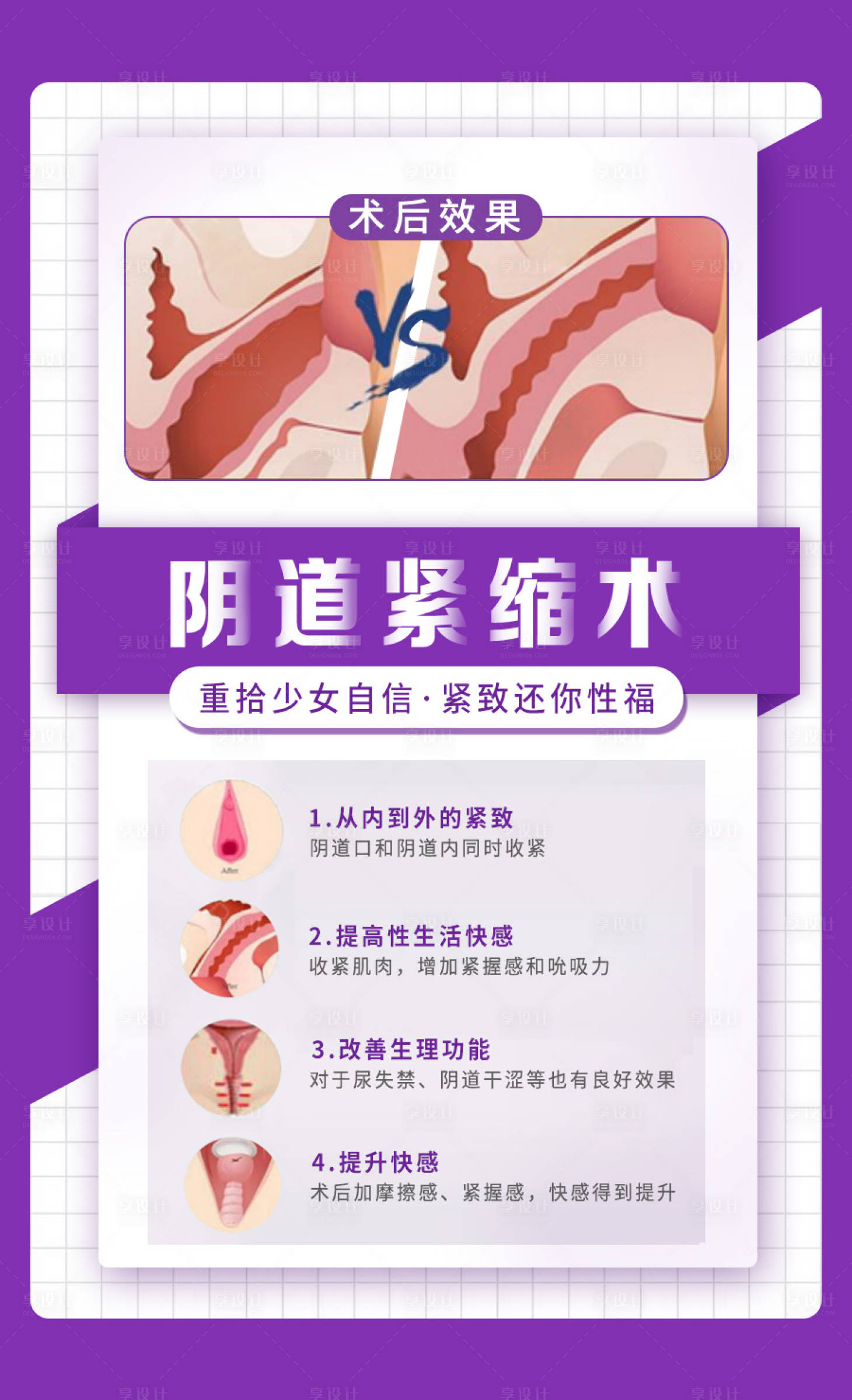 源文件下载【紧缩术】编号：22010015480666759