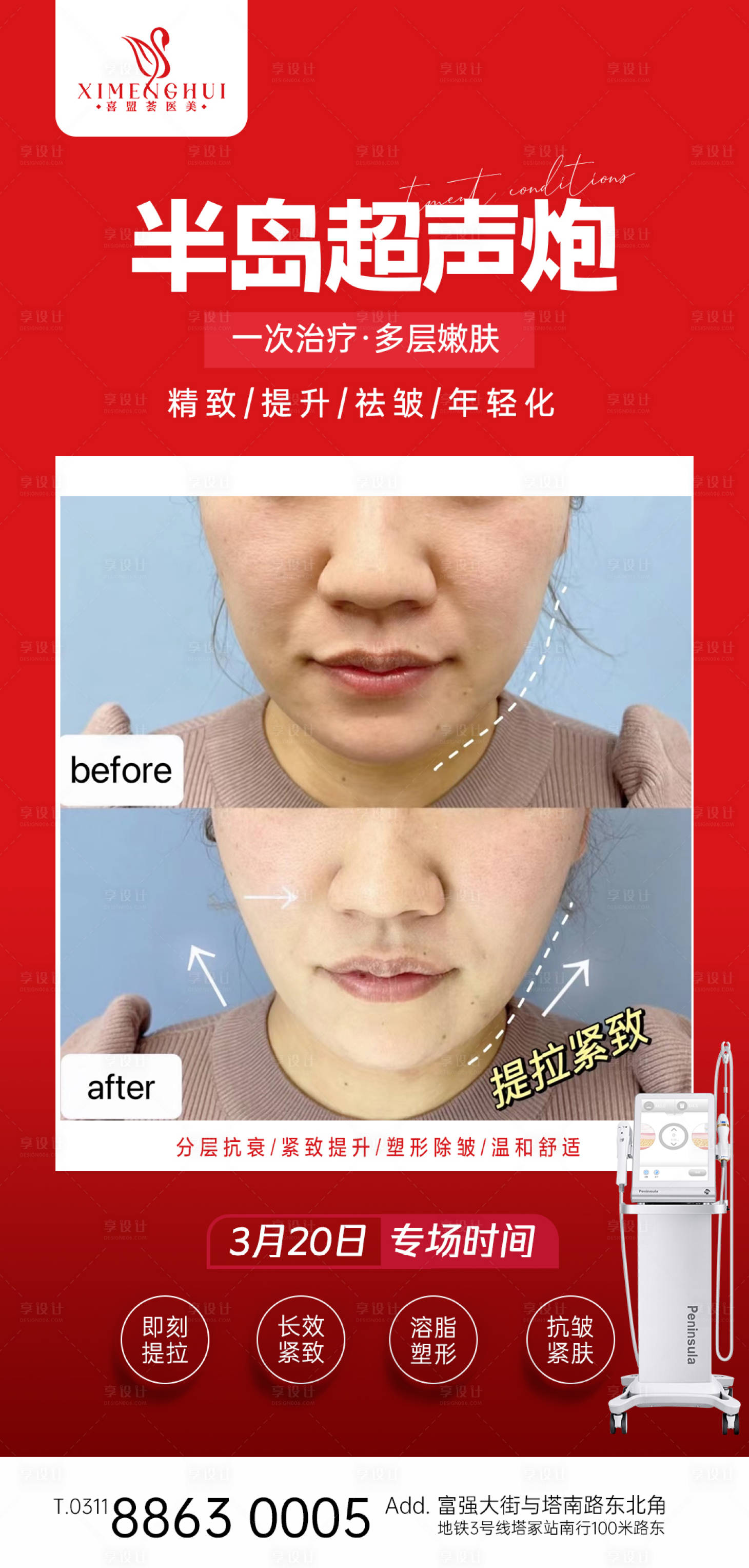 源文件下载【享设计】搜索编号：80360015434437653【超声炮案例医美整形海报】