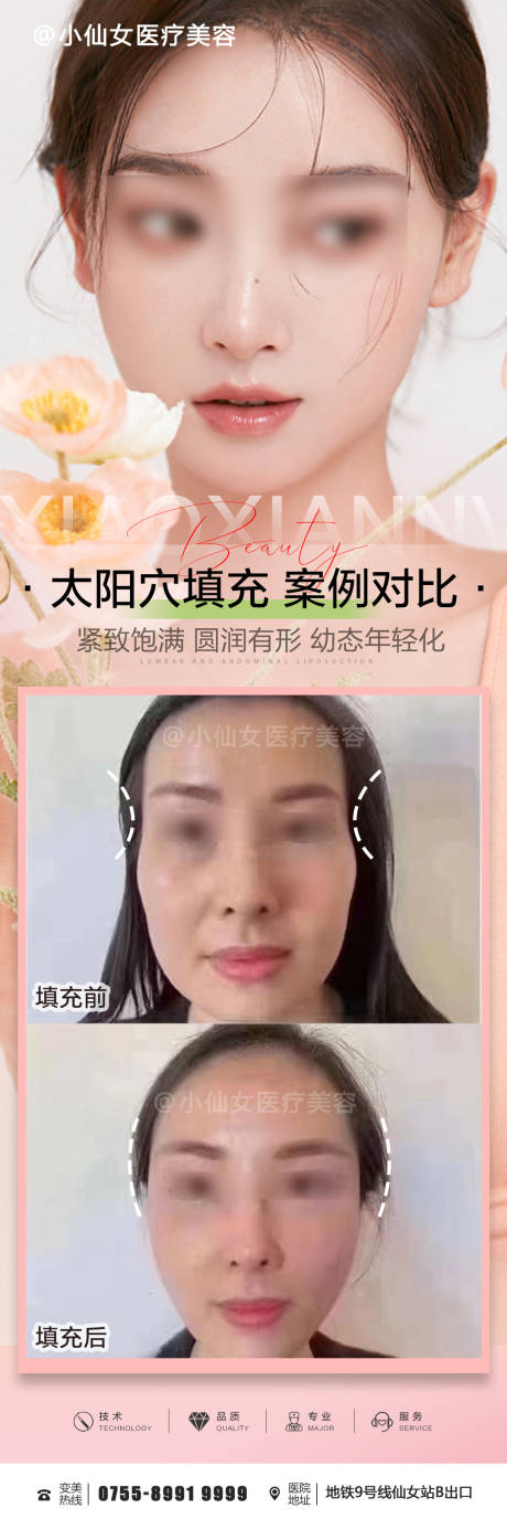 源文件下载【医美整形太阳穴填充朋友圈案例海报】编号：75400015394667009