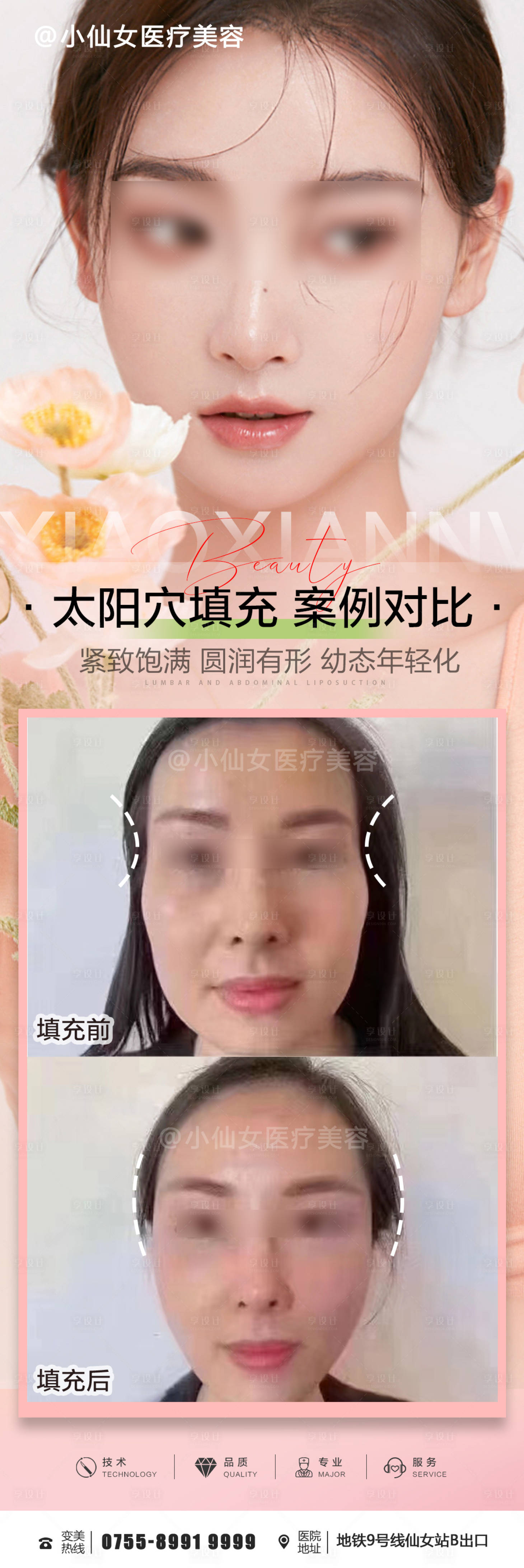 源文件下載【享設(shè)計(jì)】搜索編號(hào)：75400015394667009【醫(yī)美整形太陽(yáng)穴填充朋友圈案例海報(bào)】