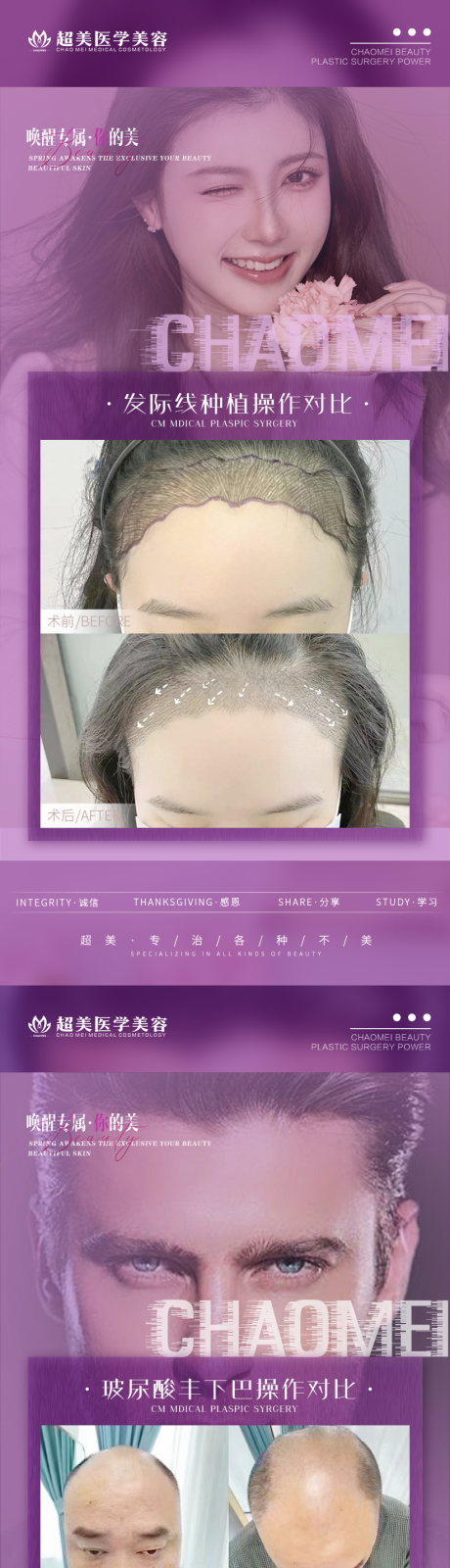 源文件下载【植发案例对比系列】编号：61470015683624972