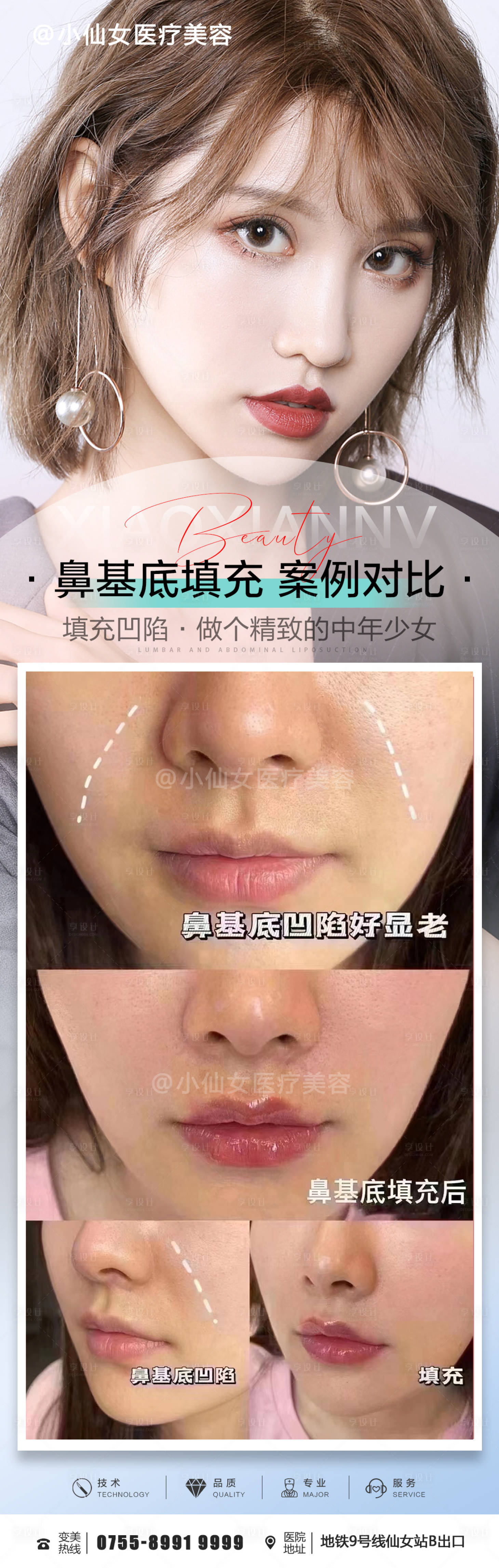 源文件下载【医美玻尿酸填充鼻基底案例海报】编号：97910015429829735