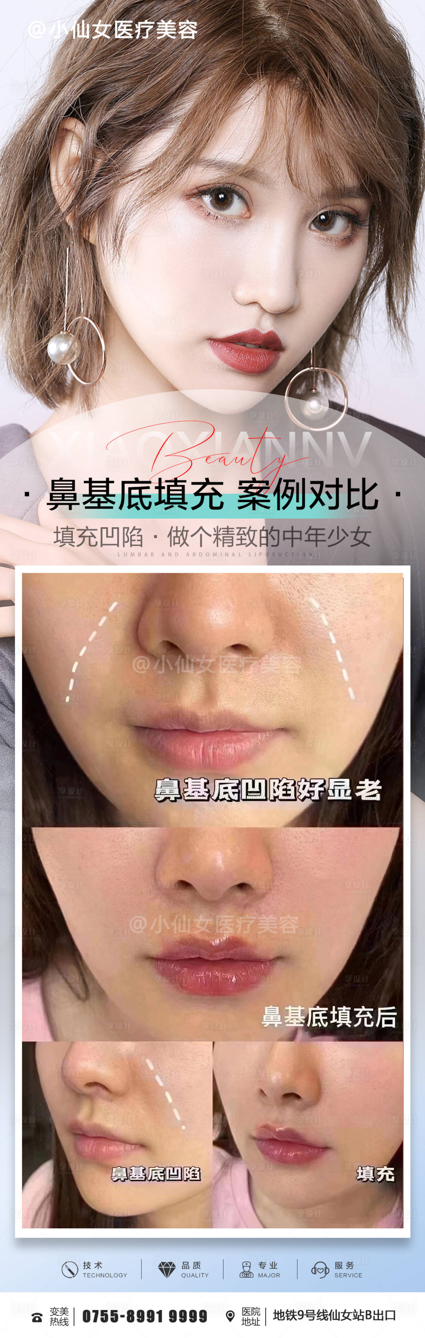 北京玻尿酸填充鼻基底法令纹 - 知乎