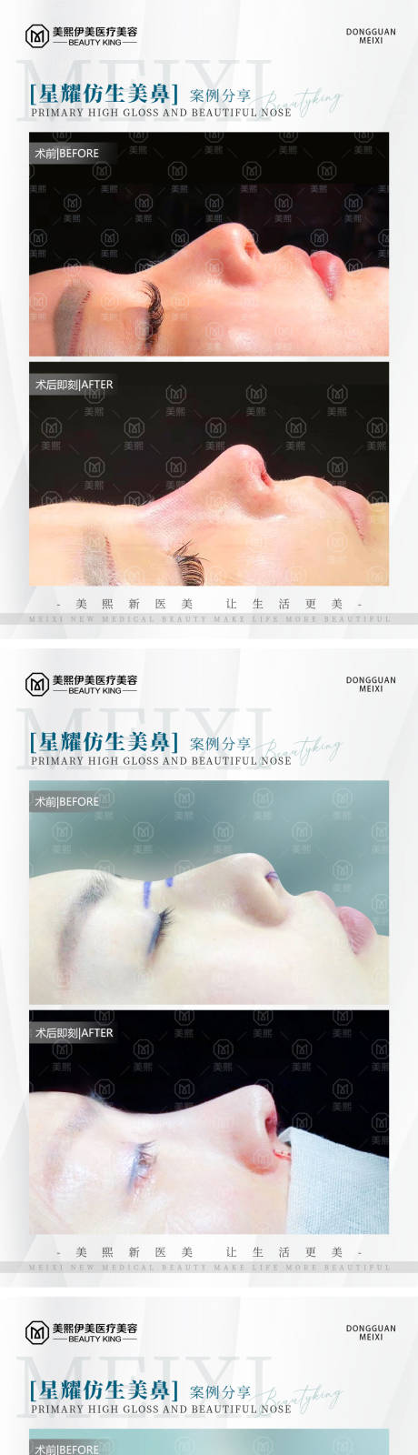 源文件下载【医美隆鼻案例系列海报 】编号：52480015372371444