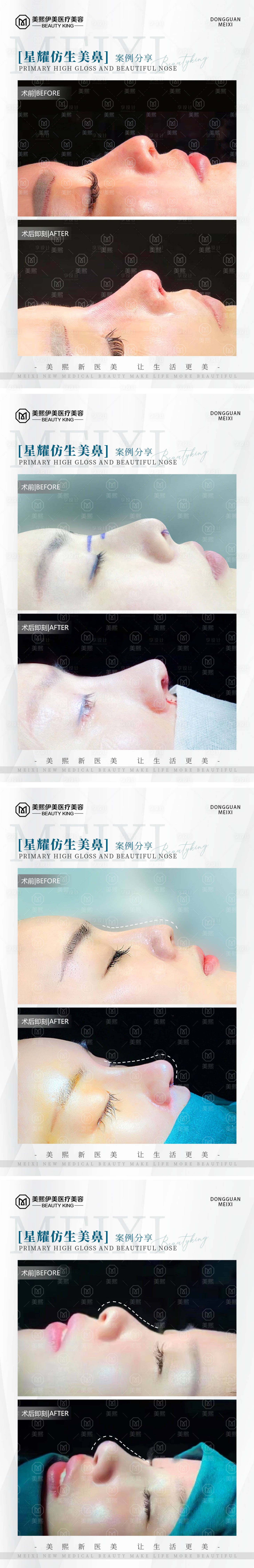 源文件下載【享設計】搜索編號：52480015372371444【醫美隆鼻案例系列海報 】