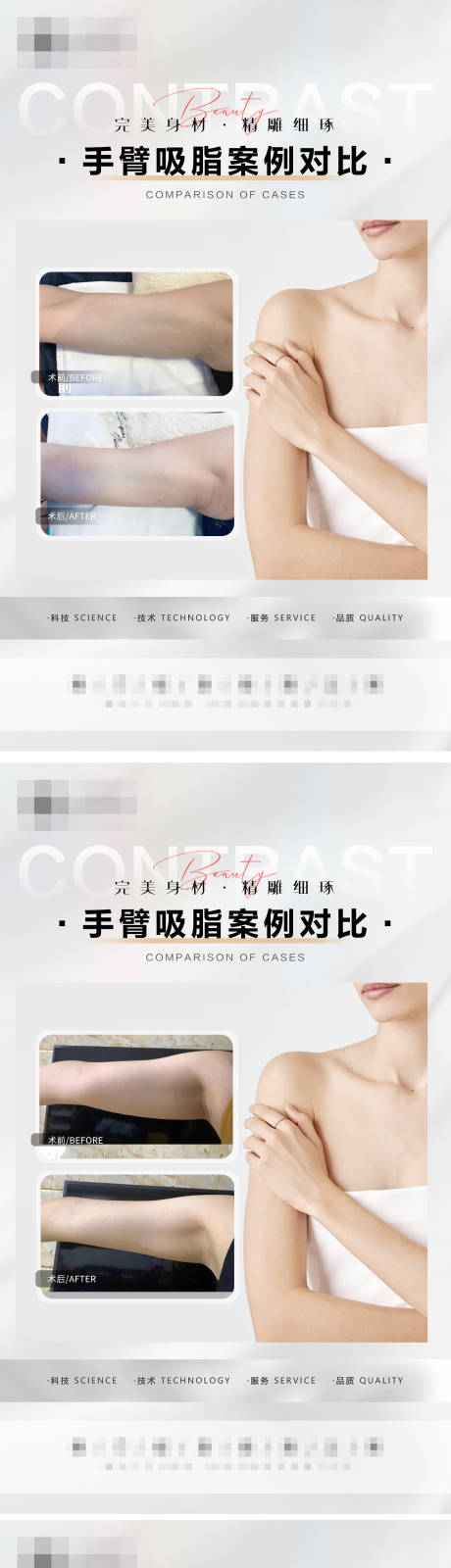 源文件下载【手臂吸脂案例系列海报】编号：43230016106167345