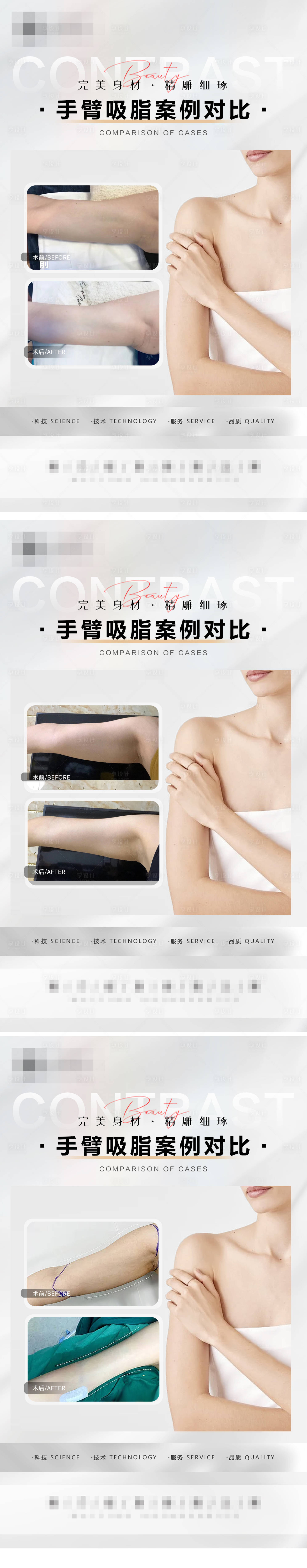 源文件下载【手臂吸脂案例系列海报】编号：43230016106167345