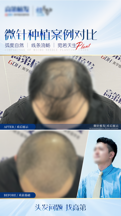 源文件下载【享设计】搜索编号：21650016060415388【植发案例海报对比图】
