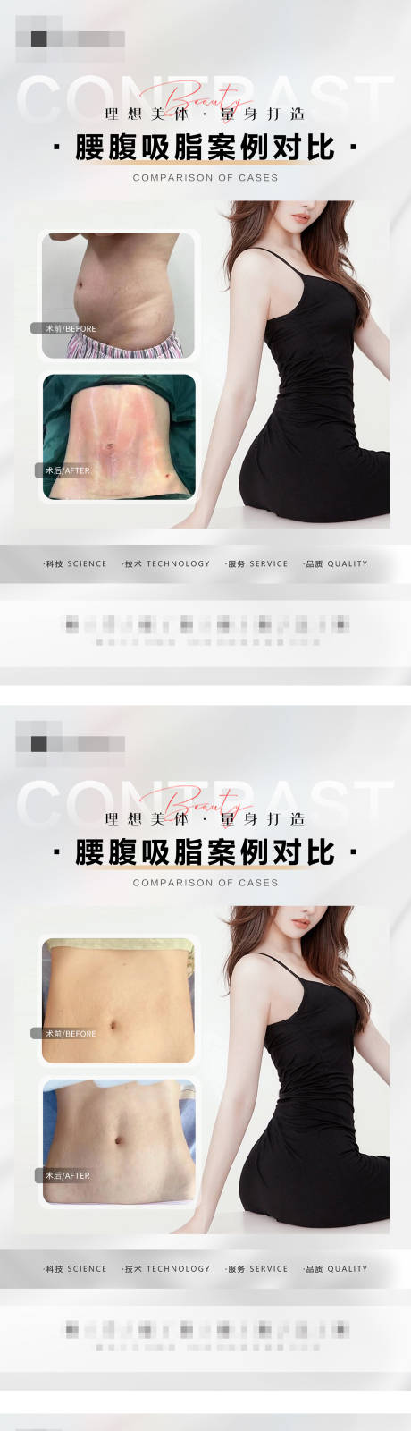 源文件下载【腰腹吸脂案例】编号：94640016106173257