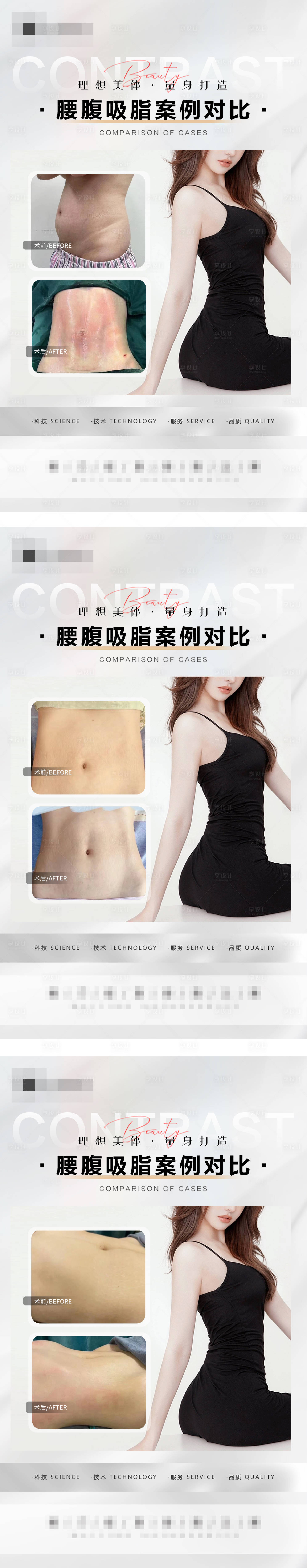 源文件下載【享設計】搜索編號：94640016106173257【腰腹吸脂案例】