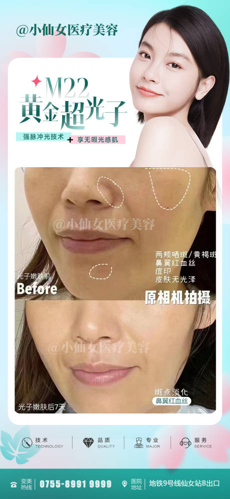 源文件下载【超光子嫩肤案例朋友圈海报】编号：33730015884038513