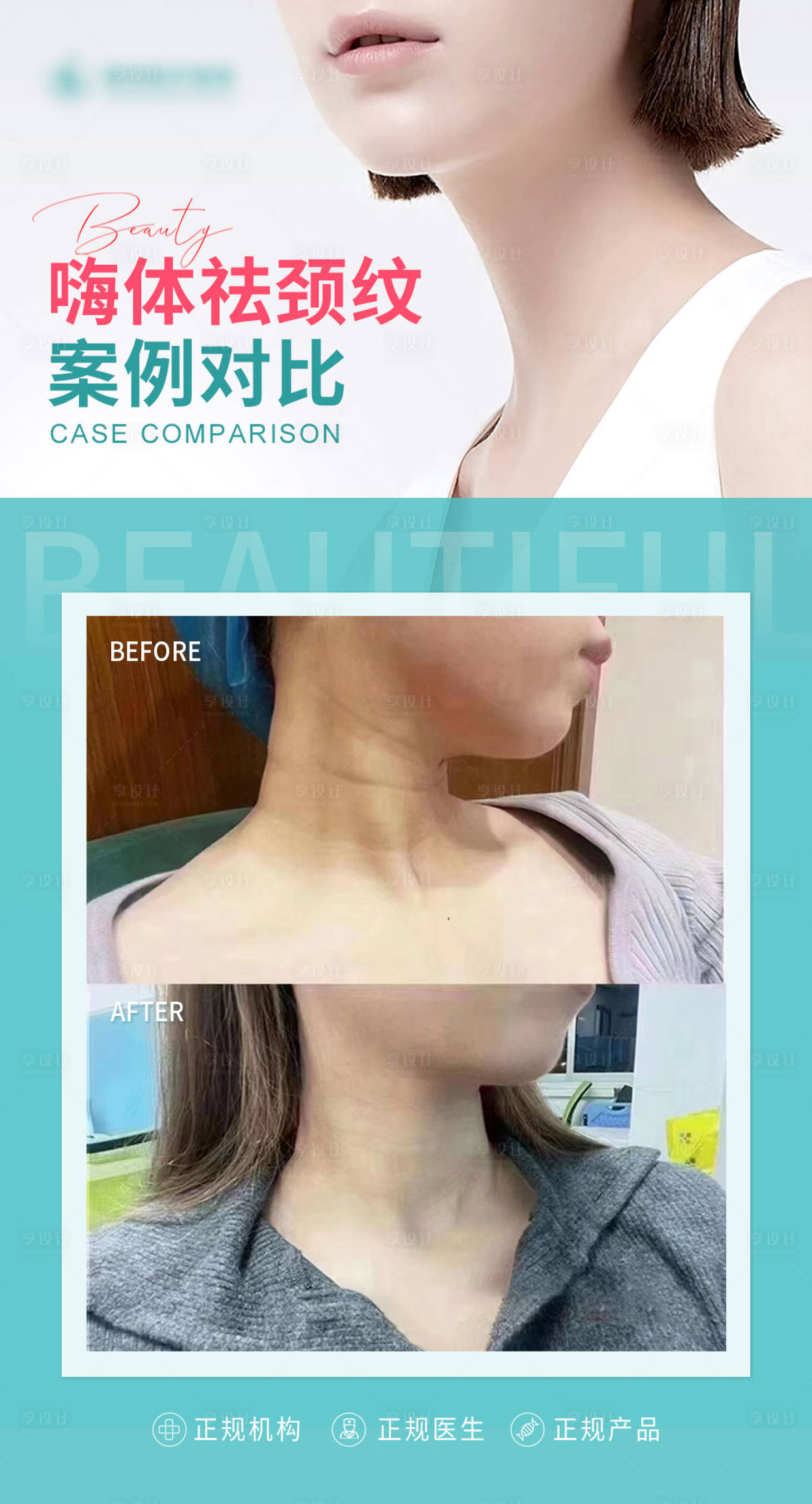 源文件下載【享設(shè)計(jì)】搜索編號：44490016139048448【醫(yī)美祛頸紋案例】