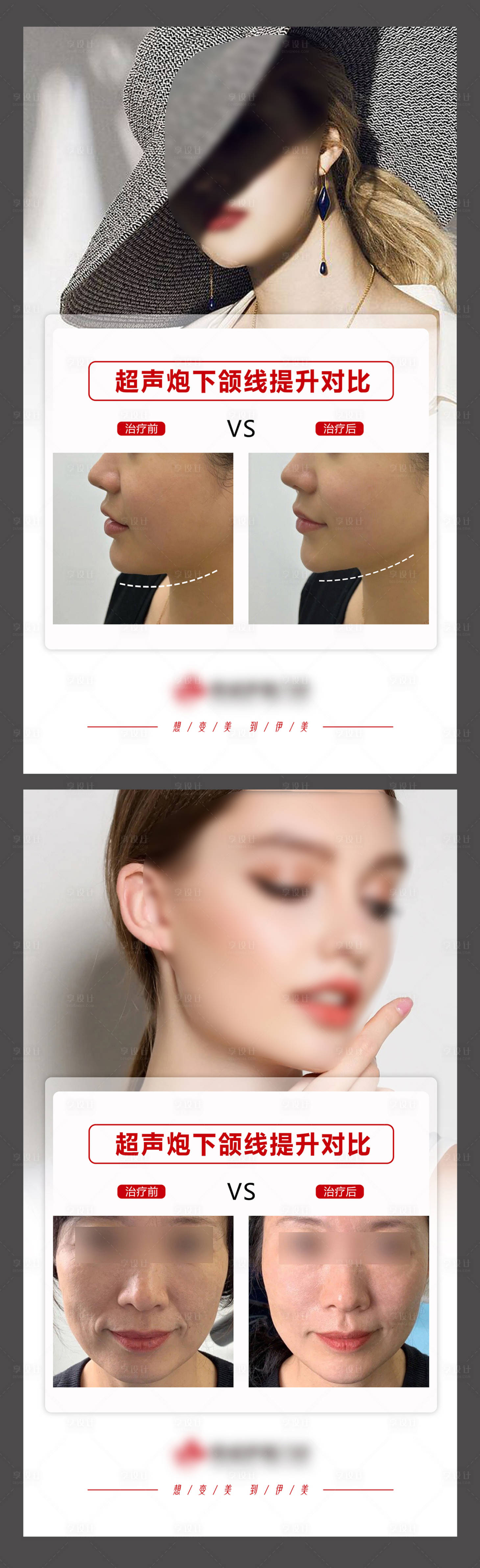 源文件下載【享設(shè)計(jì)】搜索編號(hào)：91510015865858994【醫(yī)美案例模板系列海報(bào)】