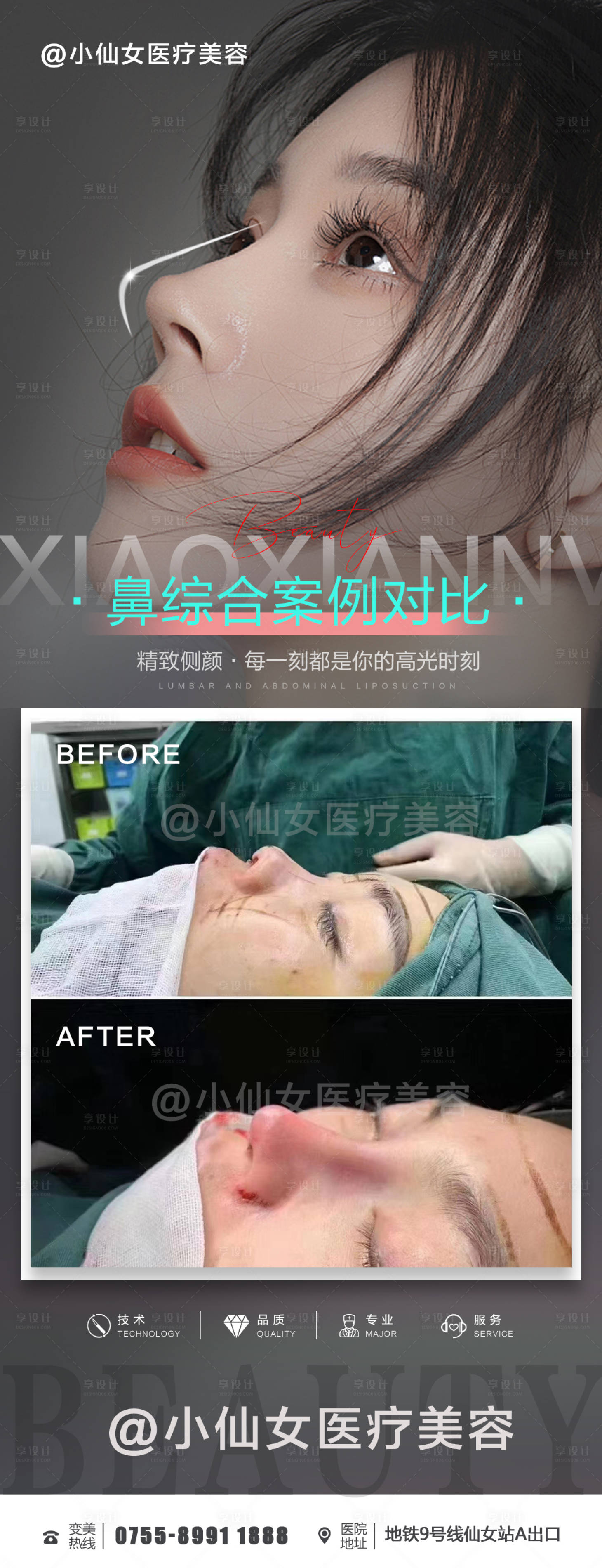 源文件下载【享设计】搜索编号：51920015880937684【医美鼻综合朋友圈案例海报】