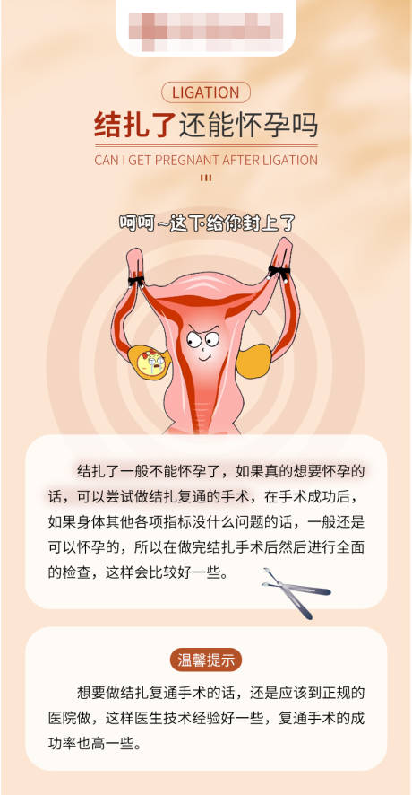 结扎科普
