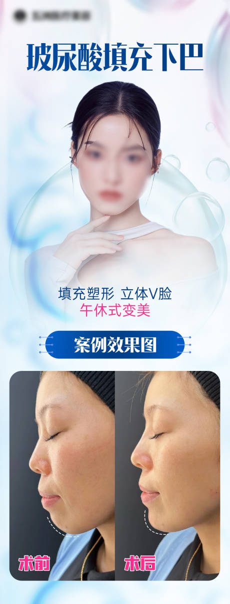 源文件下載【醫(yī)美玻尿酸案例宣傳海報】編號：75840016950996538