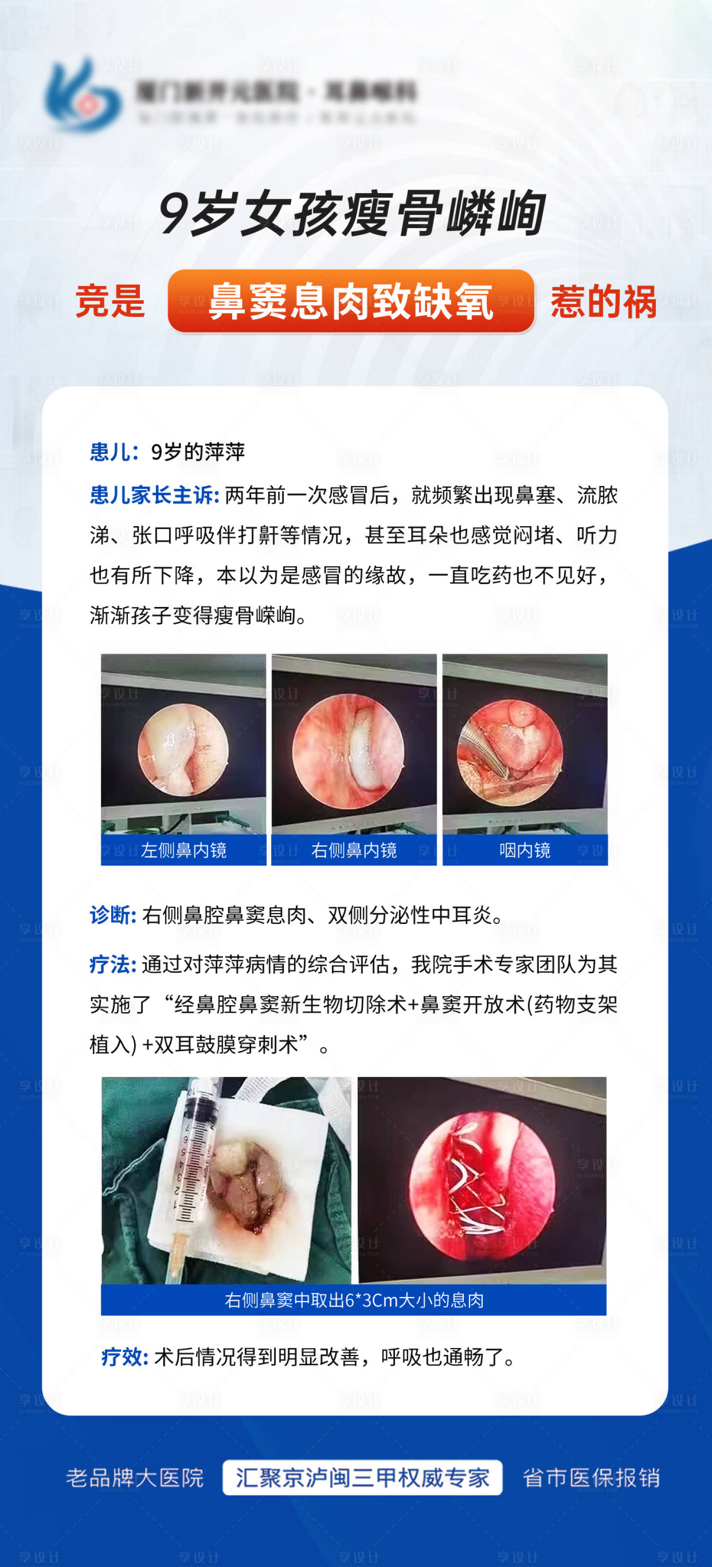 源文件下載【享設計】搜索編號：33700017007853138【耳鼻喉鼻息肉海報】