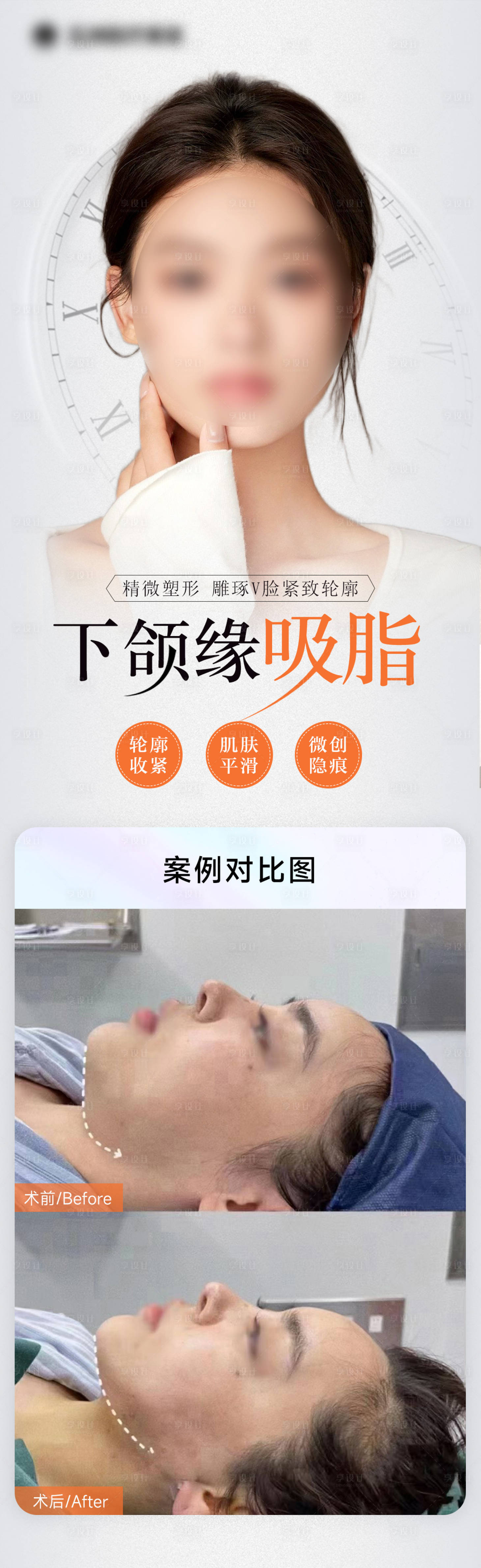 源文件下载【享设计】搜索编号：67280016477446765【医美案例海报】