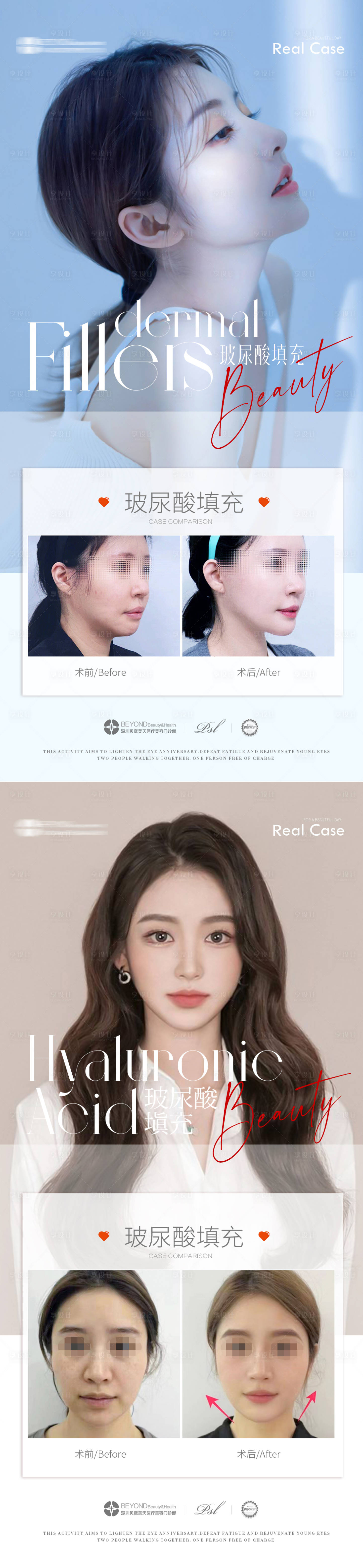 源文件下载【享设计】搜索编号：85360017053742003【医美填充案例对比】
