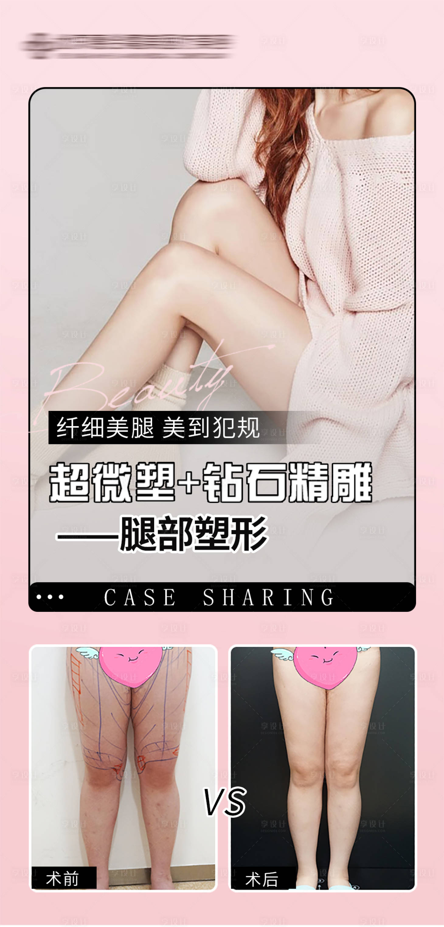 源文件下载【享设计】搜索编号：11380016972332506【医美吸脂案例对比图海报】
