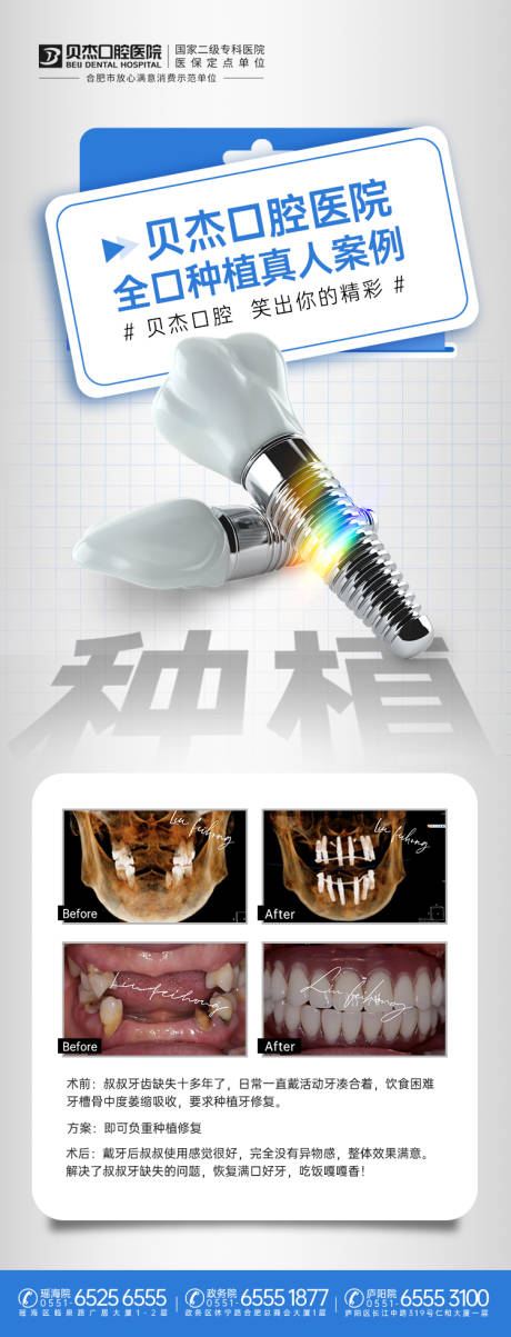 源文件下载【种植牙】编号：20230530110251914