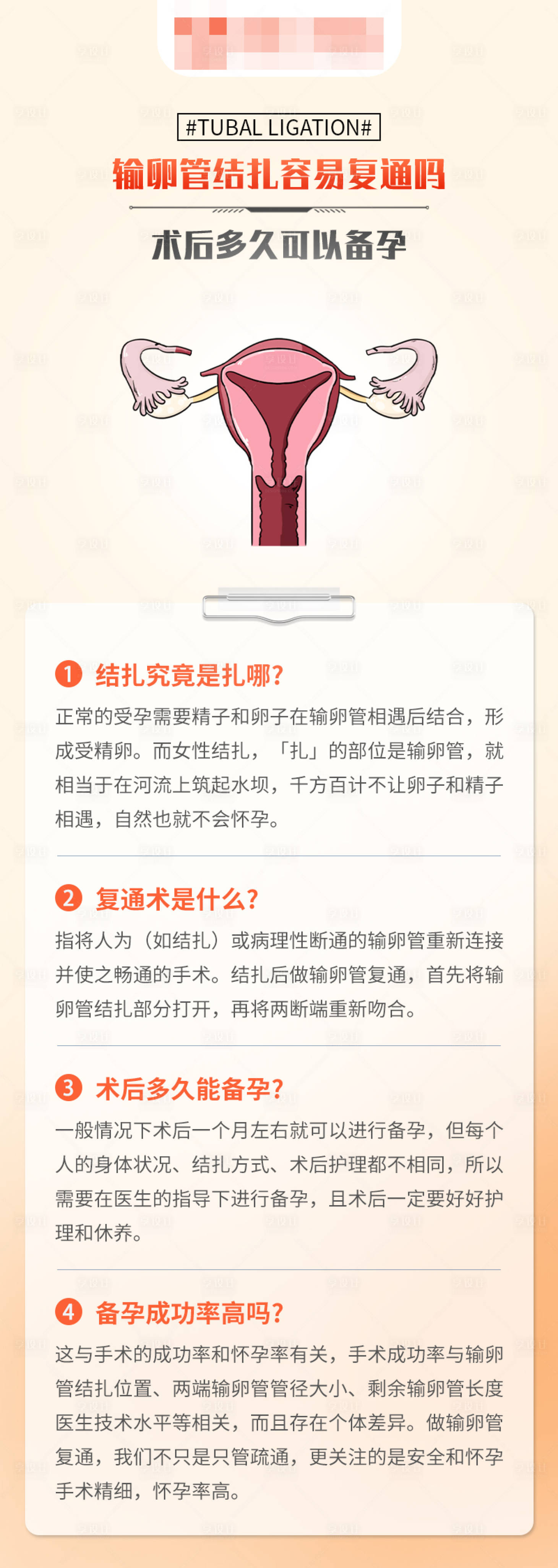 源文件下载【享设计】搜索编号：23070016674492163【输卵管结扎科普海报】