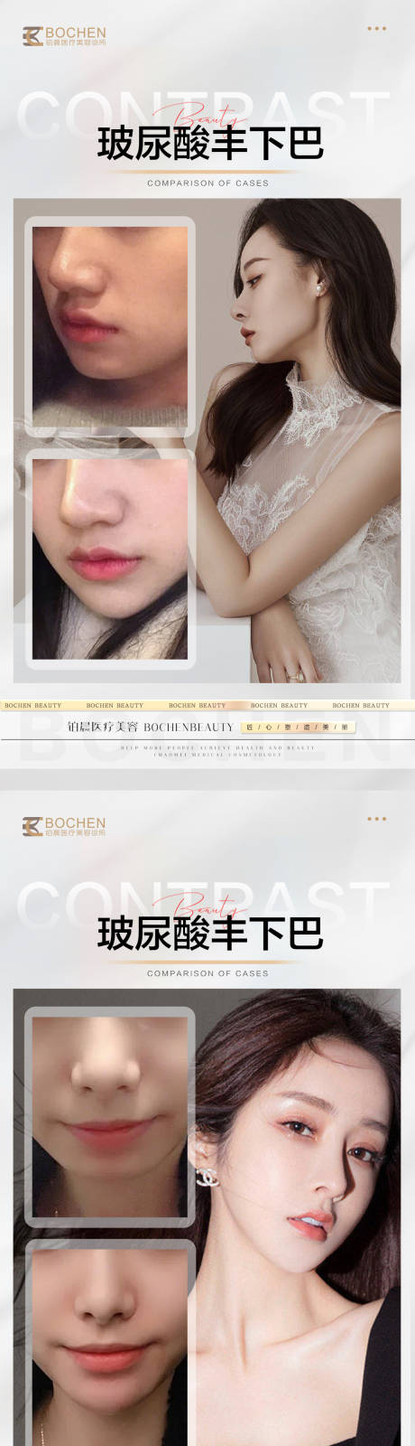 源文件下载【玻尿酸丰下巴案例】编号：75210016586983268