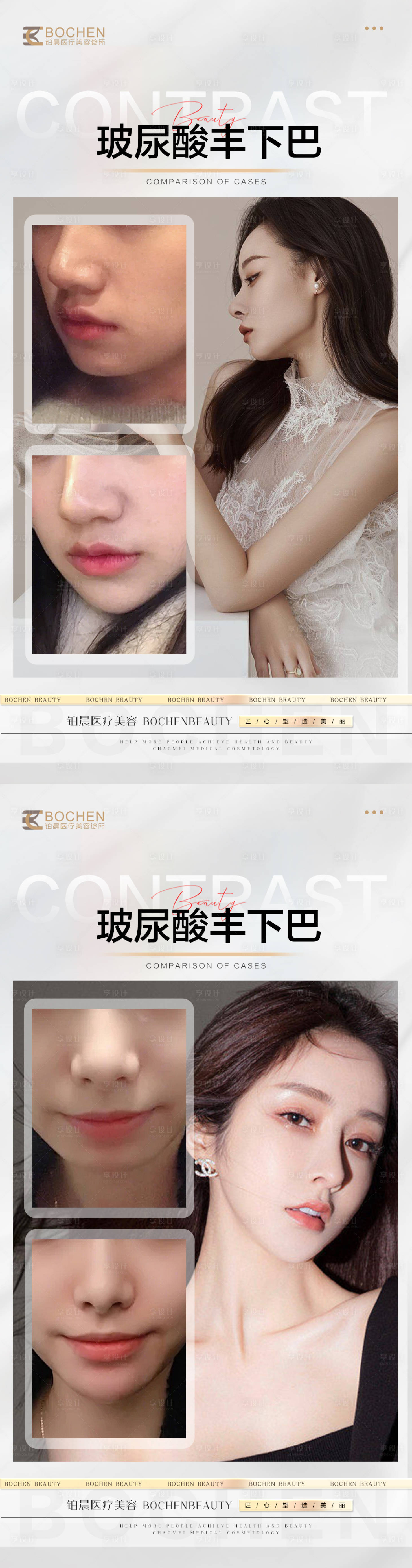 源文件下載【享設計】搜索編號：75210016586983268【玻尿酸豐下巴案例】