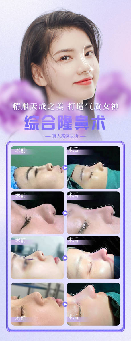 源文件下載【醫美整形鼻部隆鼻真實案例】編號：73010016695544933