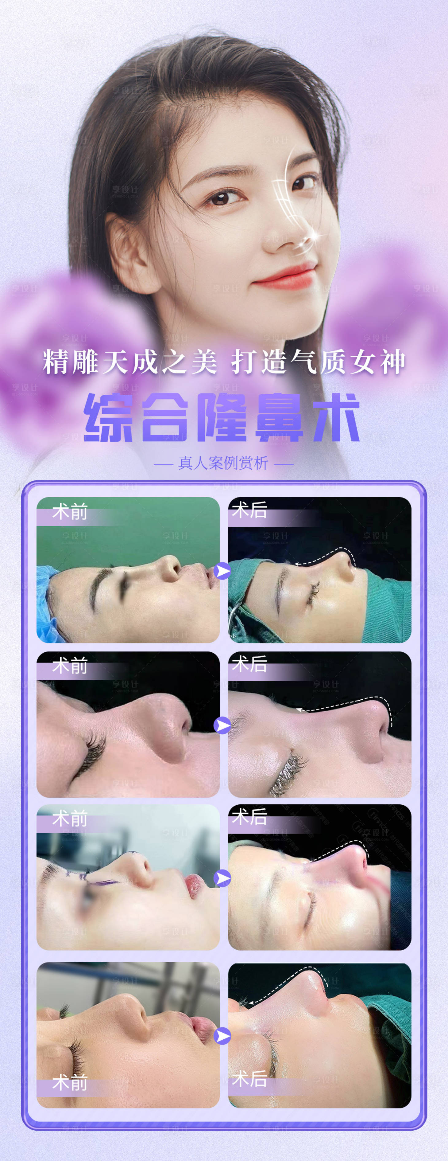源文件下載【享設計】搜索編號：73010016695544933【醫美整形鼻部隆鼻真實案例】