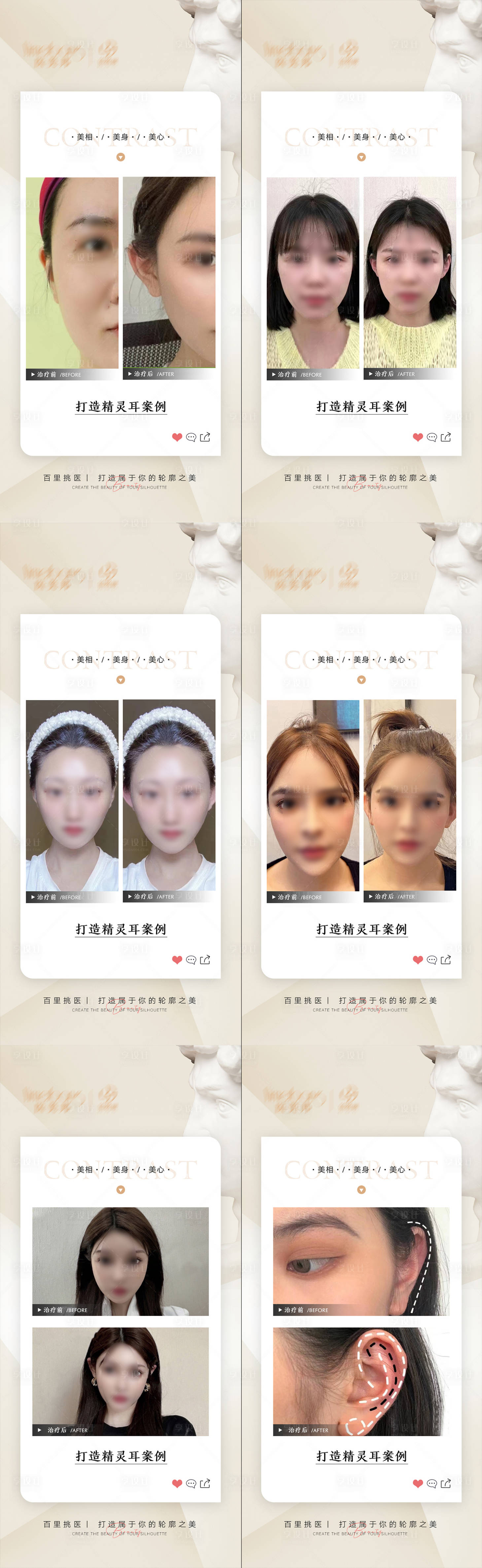 源文件下載【醫美精靈耳案例分享】編號：69390017260312607