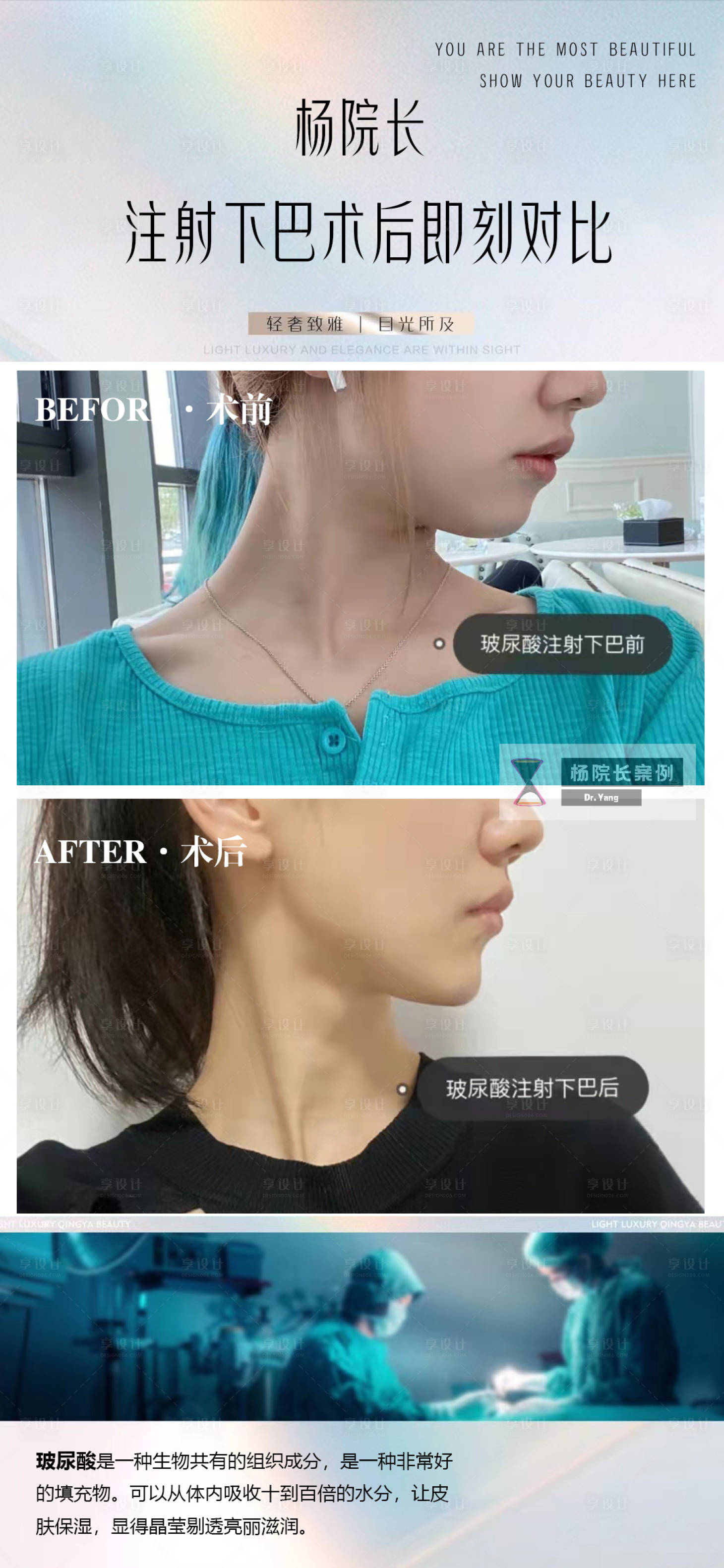源文件下載【享設計】搜索編號：36750017331229154【醫美案例對比玻尿酸注射下巴對比】