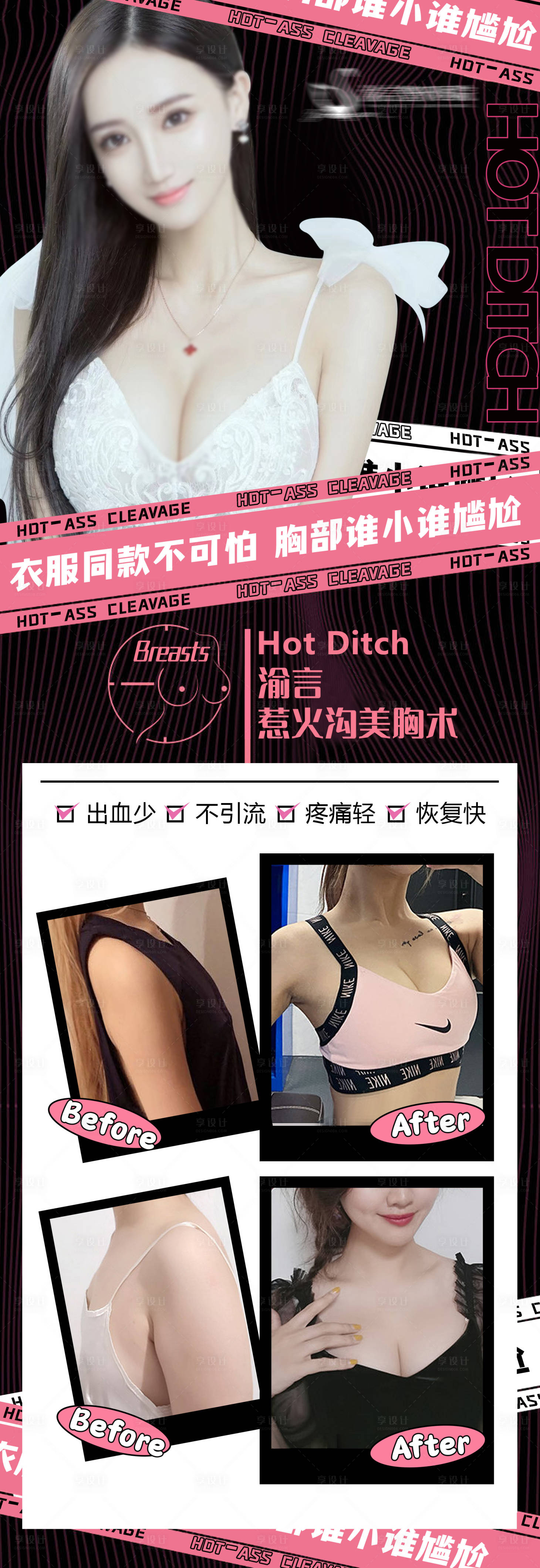 源文件下载【医美美胸术案例海报】编号：54790017134523119