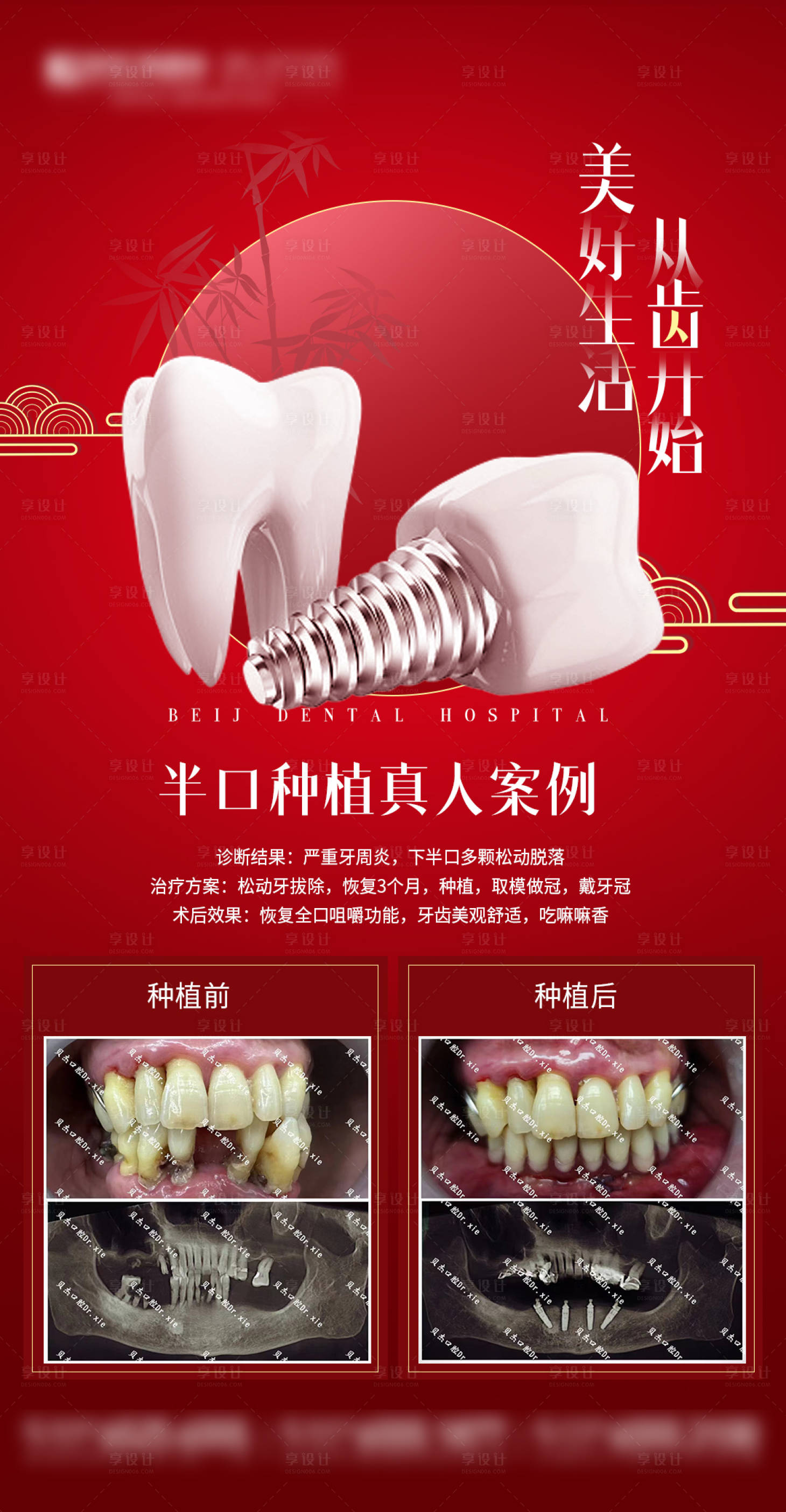 源文件下载【享设计】搜索编号：94140017135887024【种植牙案例海报】