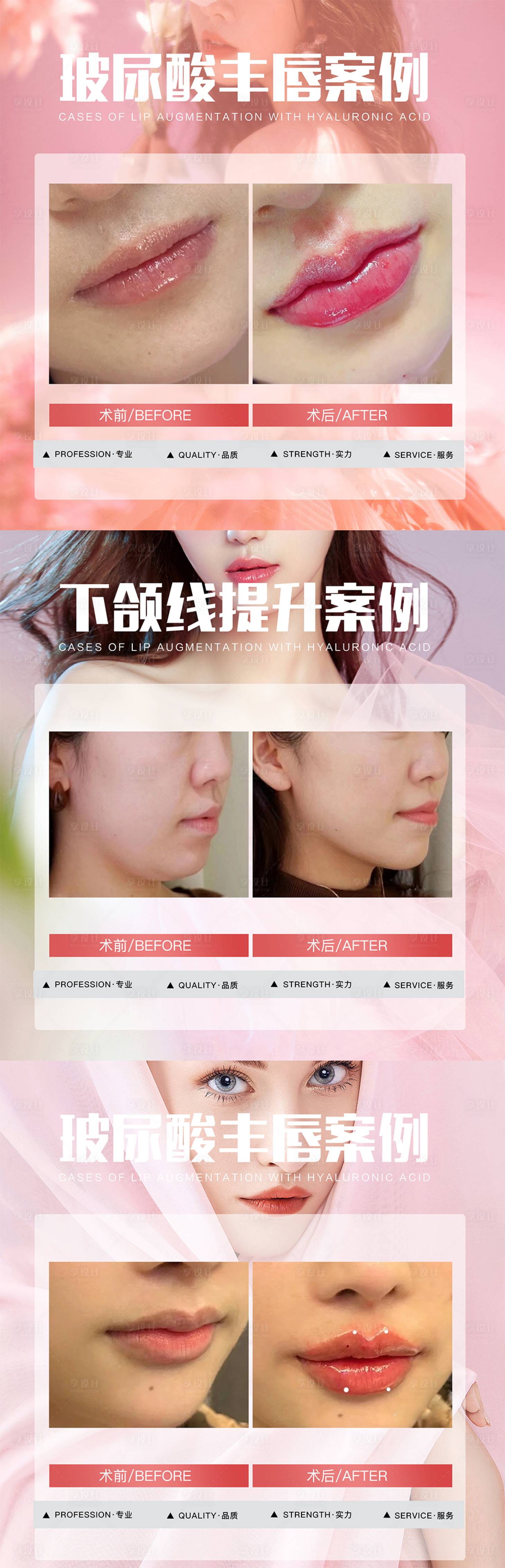 源文件下载【享设计】搜索编号：48930017291815458【医美案例海报】