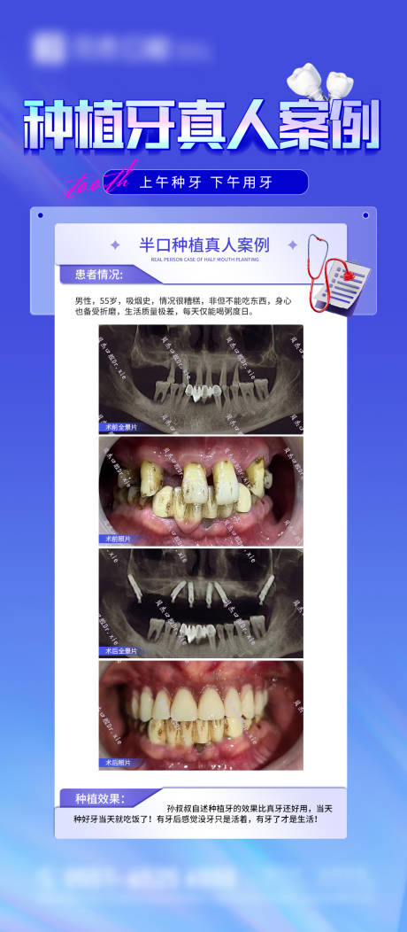 种植牙案例-源文件【享设计】